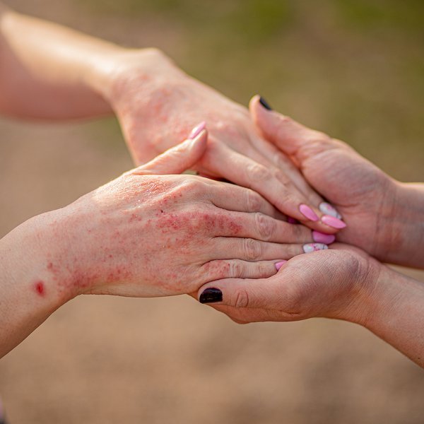 631a2b5fbb8f398acd07f38a_bigstock-Close-Up-Dermatitis-On-Skin-I-451343693